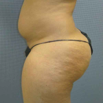 Brazilian Butt Lift Before & After Patient #4903