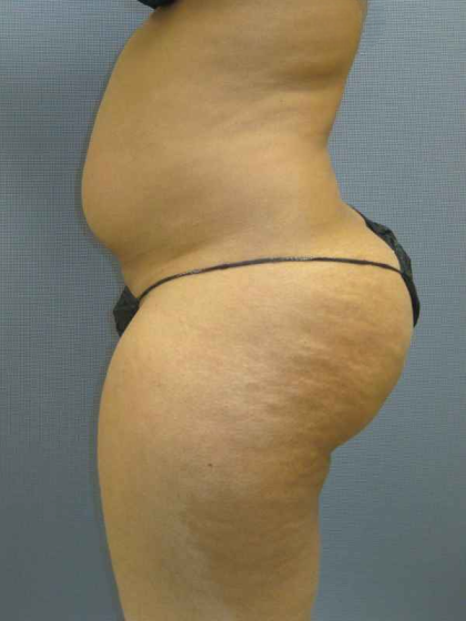 Brazilian Butt Lift Before & After Patient #4903