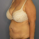 Abdominoplasty Before & After Patient #3786