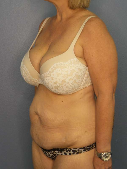 Abdominoplasty Before & After Patient #3786