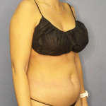 Liposuction Female Before & After Patient #8058