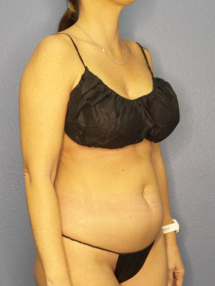 Liposuction Female Before & After Patient #8058