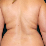 Liposuction Female Before & After Patient #7692