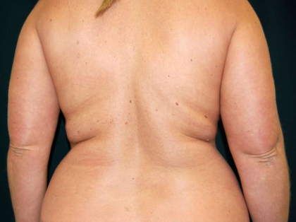 Liposuction Female Before & After Patient #7692