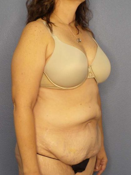 Abdominoplasty Before & After Patient #3188