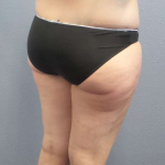 Liposuction Female Before & After Patient #7709