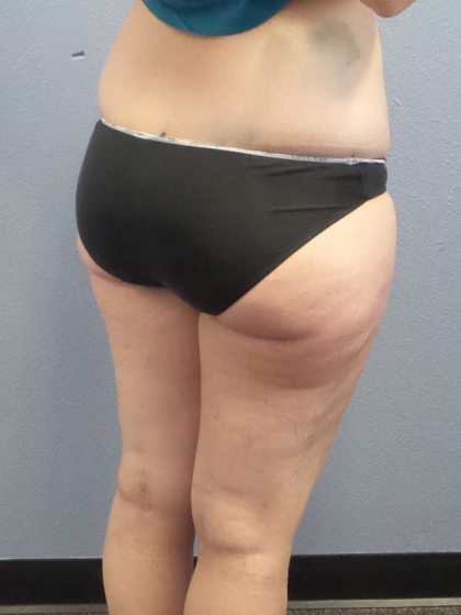 Liposuction Female Before & After Patient #7709