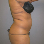 Liposuction Female Before & After Patient #7668