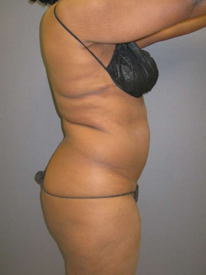 Liposuction Female Before & After Patient #7668