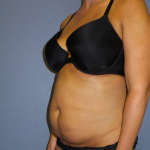 Abdominoplasty Before & After Patient #3775