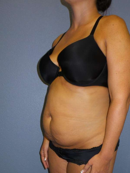 Abdominoplasty Before & After Patient #3775