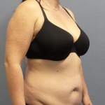 Abdominoplasty Before & After Patient #3550