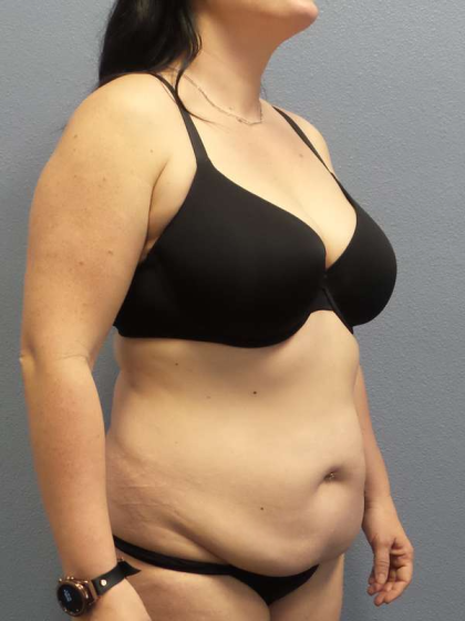 Abdominoplasty Before & After Patient #3550
