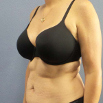 Abdominoplasty Before & After Patient #3471