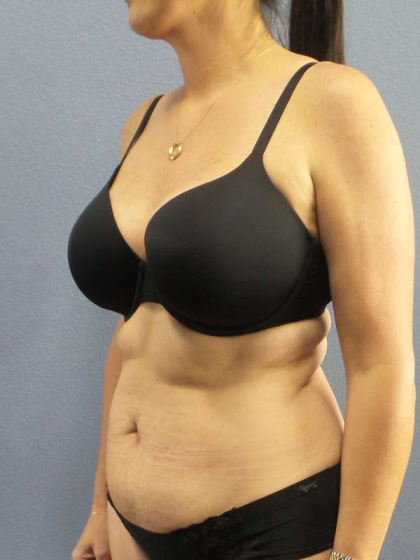 Abdominoplasty Before & After Patient #3471