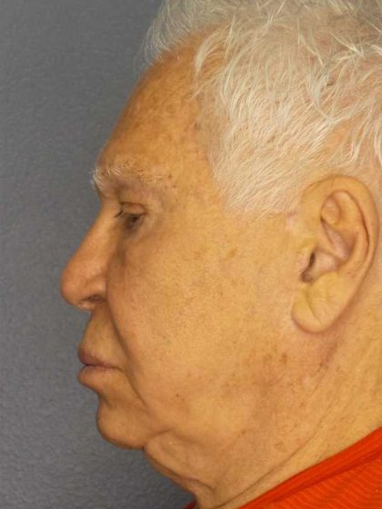 Facelift Before & After Patient #11809