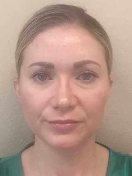 Filler Before & After Patient #11926