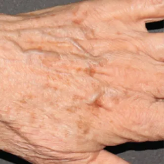 BroadBand Light (BBL™) Before & After Patient #13246