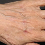 BroadBand Light (BBL™) Before & After Patient #13246