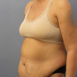 Abdominoplasty Before & After Patient #3594