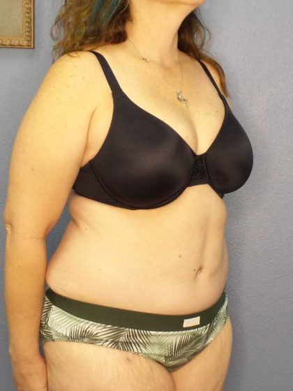 High BMI (Larger Patients) Surgery Before & After Patient #10272