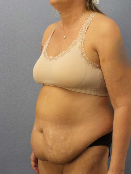 Abdominoplasty Before & After Patient #3594