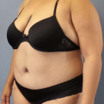 Abdominoplasty Before & After Patient #3437