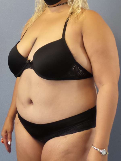 Abdominoplasty Before & After Patient #3437