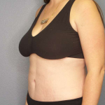 Abdominoplasty Before & After Patient #3409