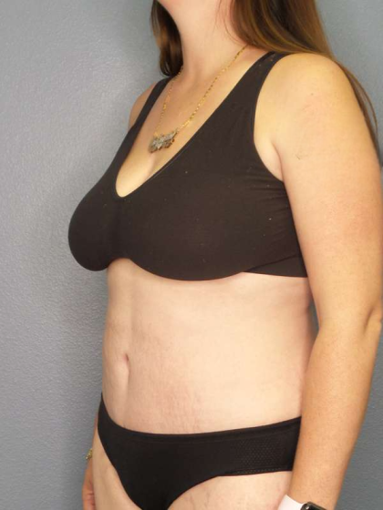 Abdominoplasty Before & After Patient #3409