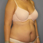 Abdominoplasty Before & After Patient #3350