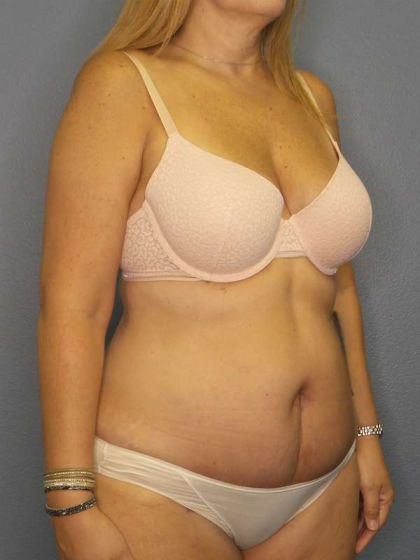 Abdominoplasty Before & After Patient #3350
