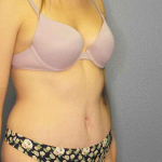 Abdominoplasty Before & After Patient #3236