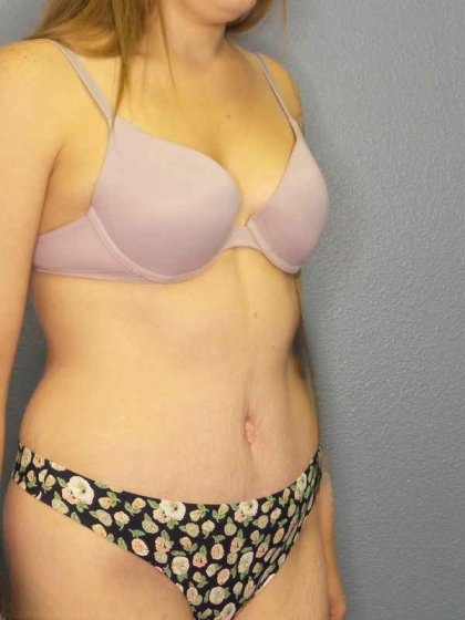 Abdominoplasty Before & After Patient #3236