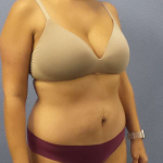 Abdominoplasty Before & After Patient #3225
