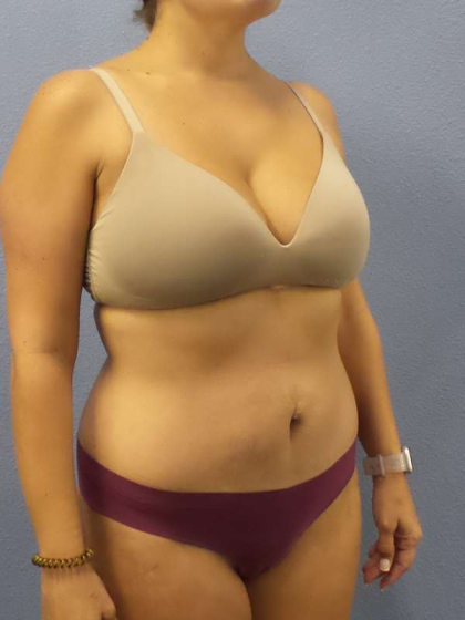 Abdominoplasty Before & After Patient #3225