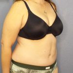 Abdominoplasty Before & After Patient #3188