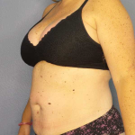 Liposuction Female Before & After Patient #11950