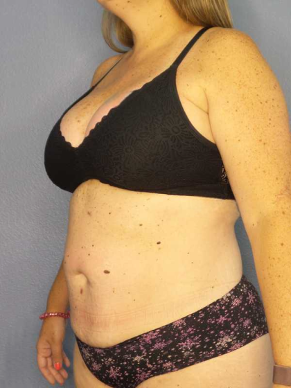 Liposuction Female Before & After Patient #11950