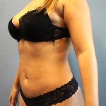 Liposuction Female Before & After Patient #11933
