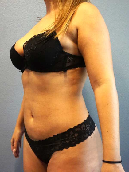 Liposuction Female Before & After Patient #11933