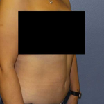 Abdominoplasty Before & After Patient #11131