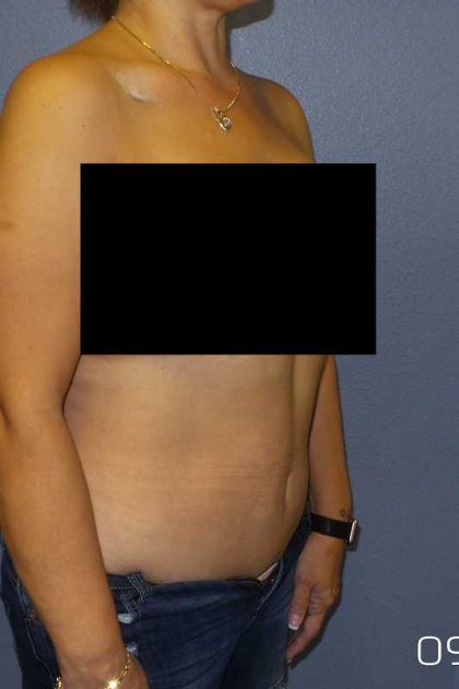 Abdominoplasty Before & After Patient #11131