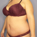 High BMI (Larger Patients) Surgery Before & After Patient #10378