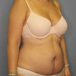 High BMI (Larger Patients) Surgery Before & After Patient #10329