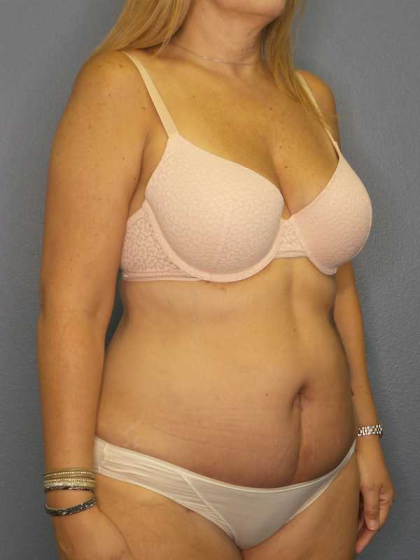 High BMI (Larger Patients) Surgery Before & After Patient #10329