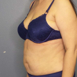 Liposuction Female Before & After Patient #7932