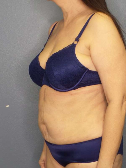 Liposuction Female Before & After Patient #7932