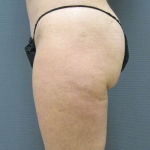 Liposuction Female Before & After Patient #7794