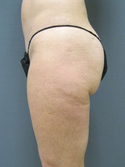 Liposuction Female Before & After Patient #7794